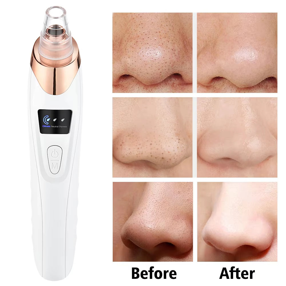 Aspirateur de Points Noirs Électrique - Nettoyeur de Pores Rechargeable