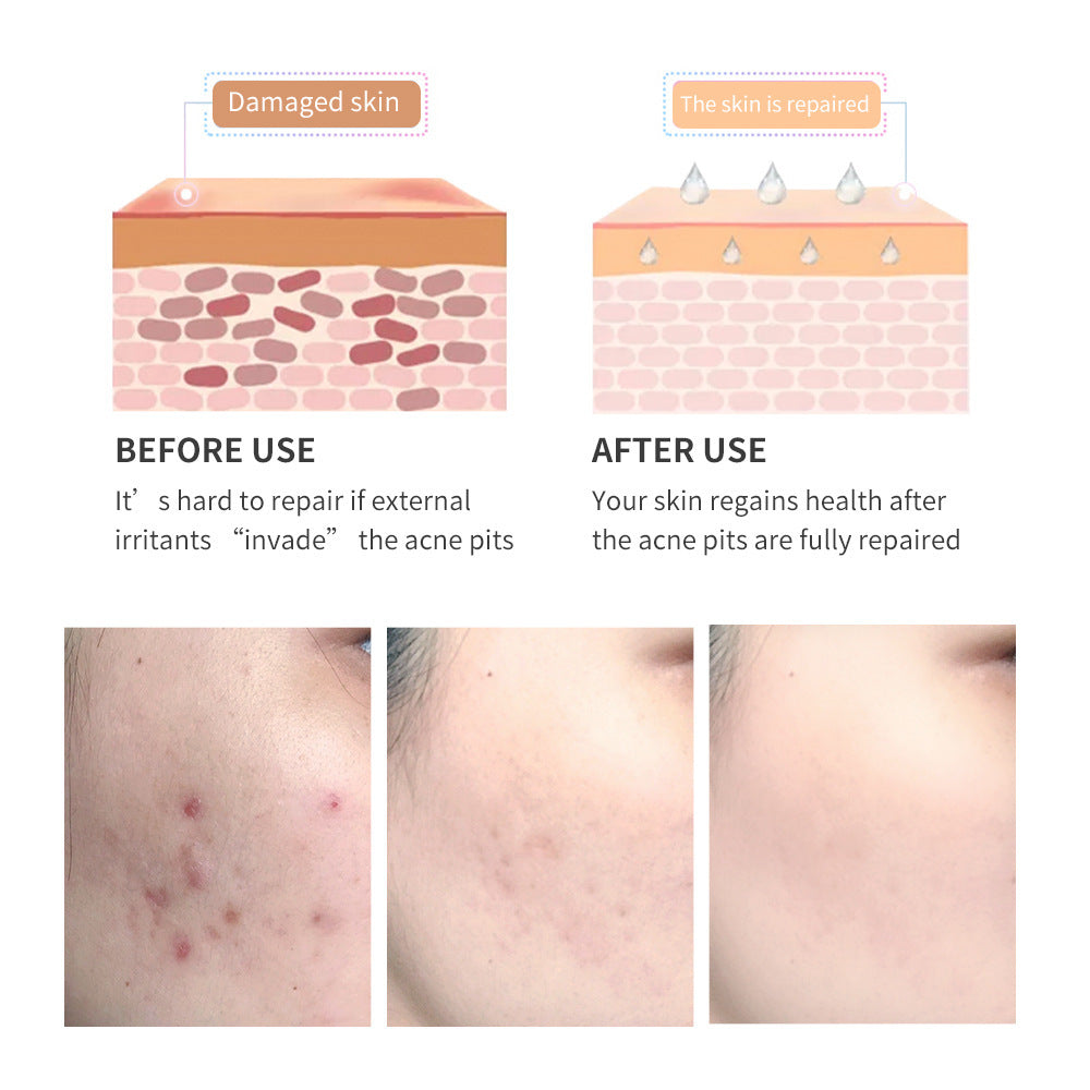 Gel Réparateur Anti-Cicatrices d’Acné – Arbre à Thé & Acide Salicylique | Sérénaya