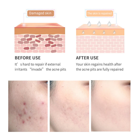Gel Réparateur Anti-Cicatrices d’Acné – Arbre à Thé & Acide Salicylique | Sérénaya